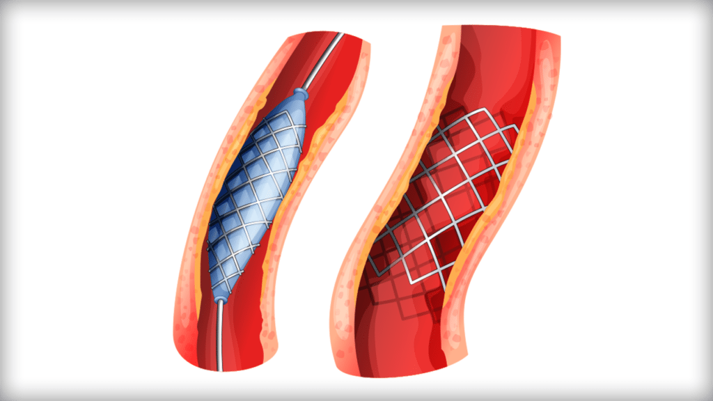 Angioplasty and stenting image