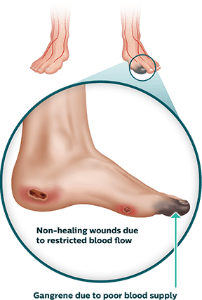 Non-healing Wounds image