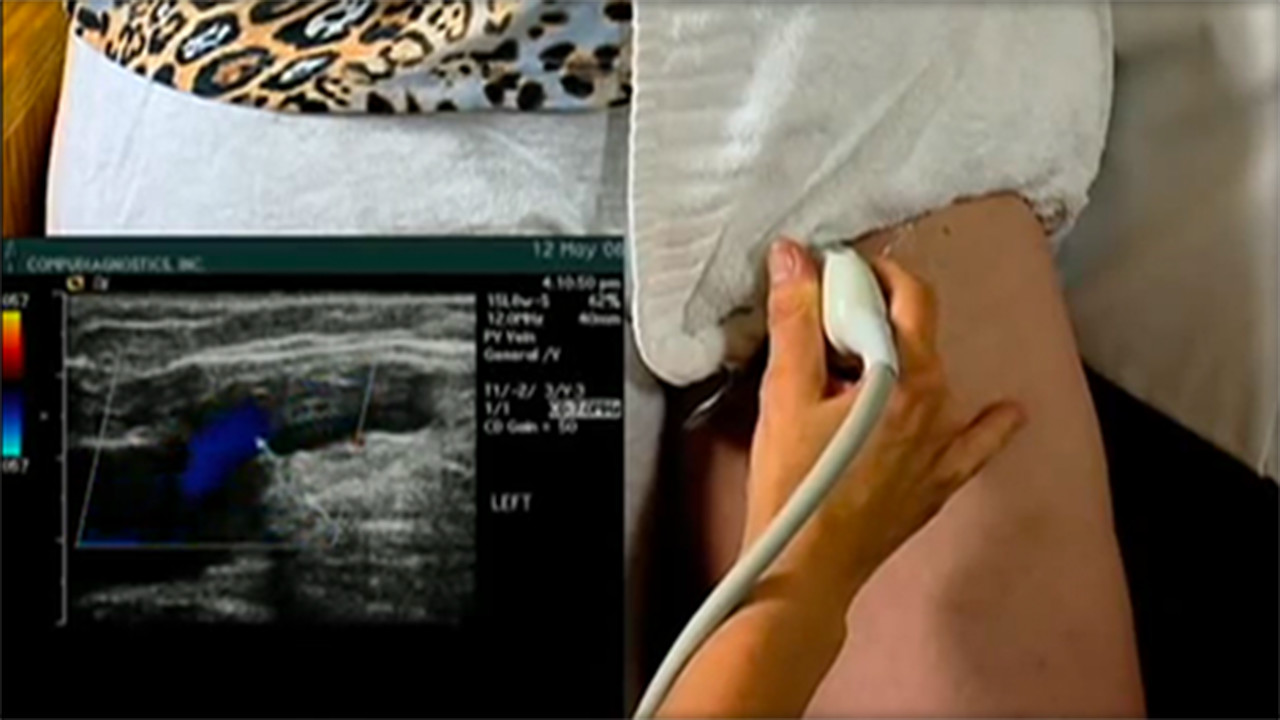 Duplex ultrasound image