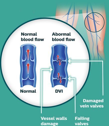 DVI illustration