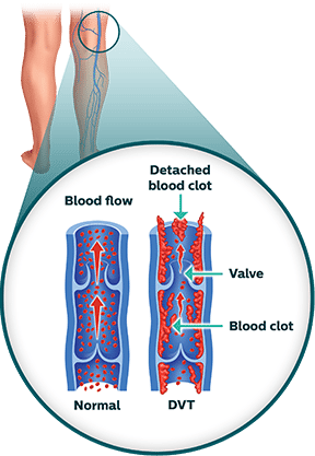 Deep Vein Thrombosis (DVT) - Symptoms and Diagnosis