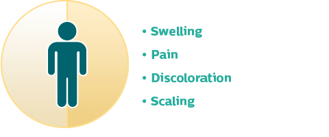 Bullet points of pain, swelling, discoloration, and scaling.