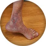 Ankle moderate venous ulcer icon