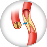 Clogged artery icon