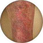 Venous eczema on the front calf icon