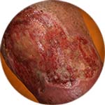 Large venous ulcer icon