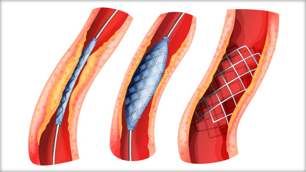 Angioplasty stenting image