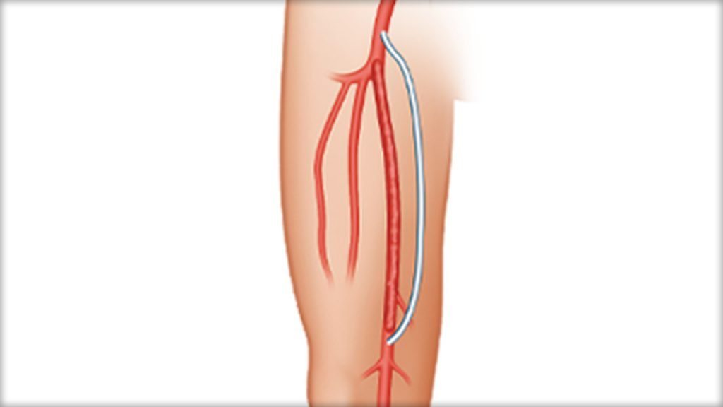 Bypass grafting