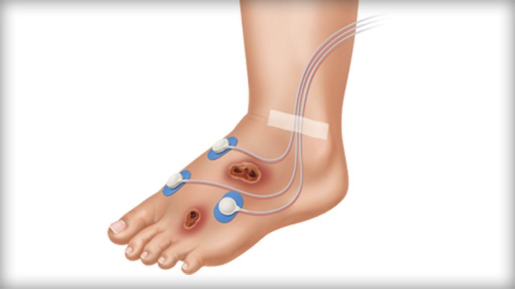 Transcutaneous pulse oximetry image