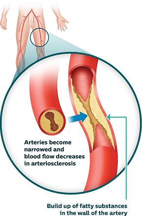 Peripheral Artery Disease (PAD): Symptoms & Treatment