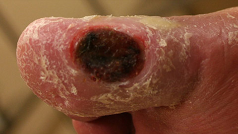 Arterial ulcer on the big toe