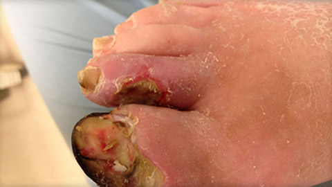 Arterial ulcer toes