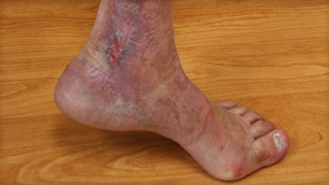 Venous ulcer on the ankle