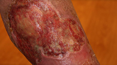 Venous ulcer on the calf