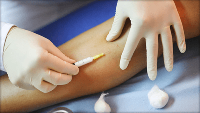 Sclerotherapy procedure