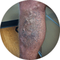 Varicose vein image