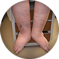 Swelling ankles