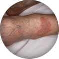 Skin damage from varicose veins