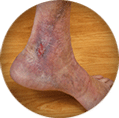 Non-healing leg ulcer