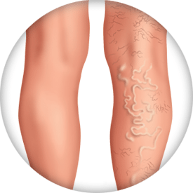 Varicose Veins  Johns Hopkins Medicine