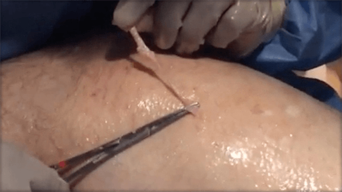 Phlebectomy procedure