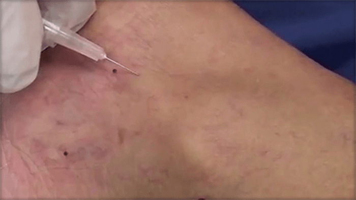 Sclerotherapy video