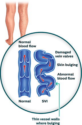 SVI illustration 