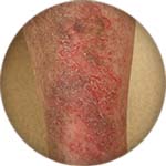 Venous eczema on the front calf icon